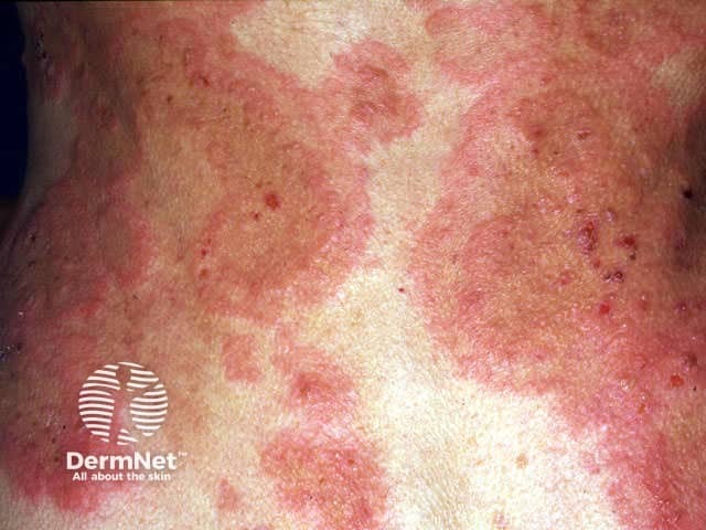 Erythema gyratum repens