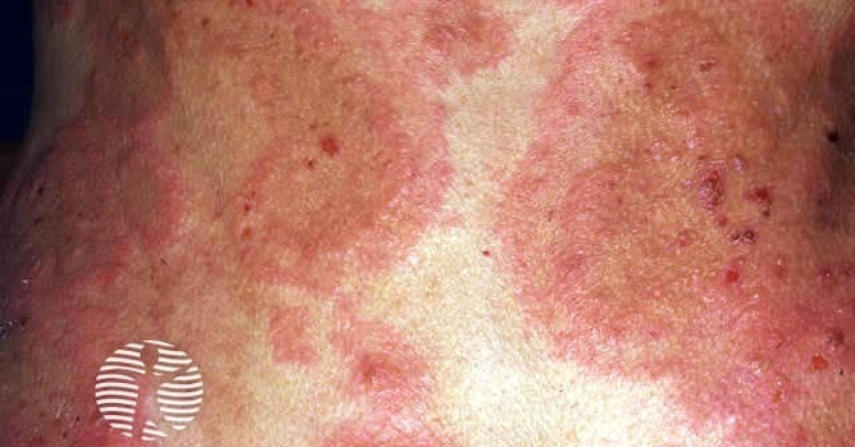 DermNet® - Erythema gyratum repens image