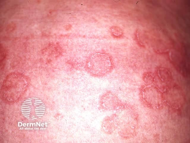 Erythema annulare centrifugum