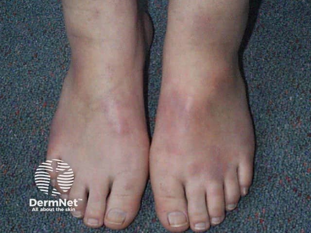 Erythema nodosum