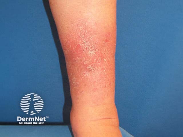 Pretibial myxoedema