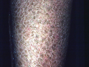 Acquired ichthyosis