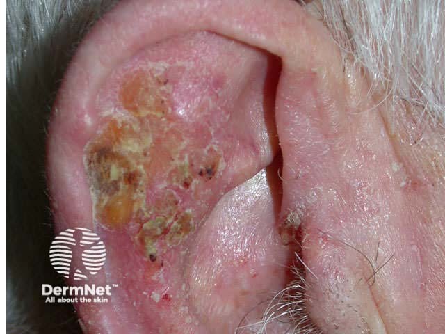 Squamous cell carcinoma in situ