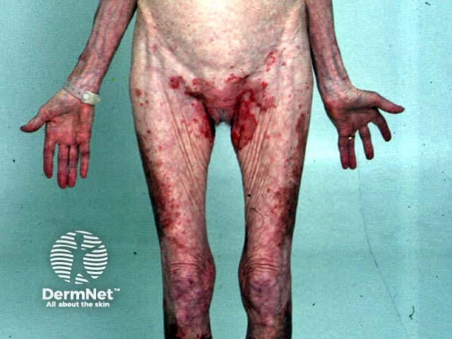 Necrolytic migratory erythema