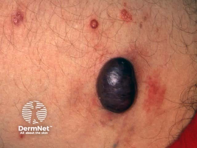 Kaposi's sarcoma