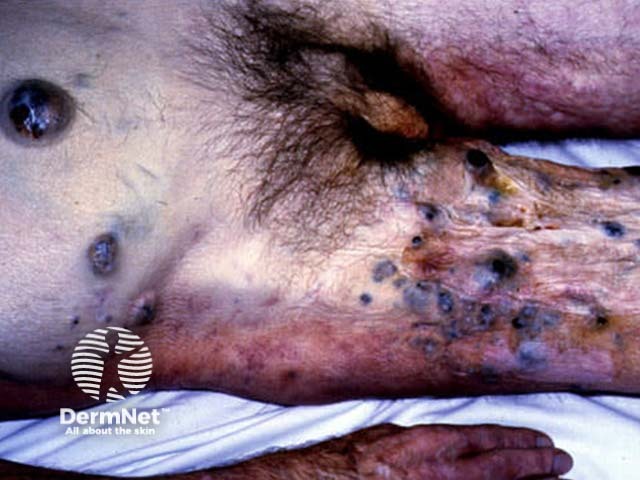 Cutaneous metastases