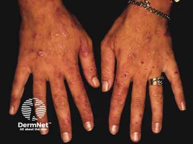 Hands in variegate porphyria