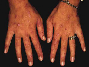 Hands in variegate porphyria