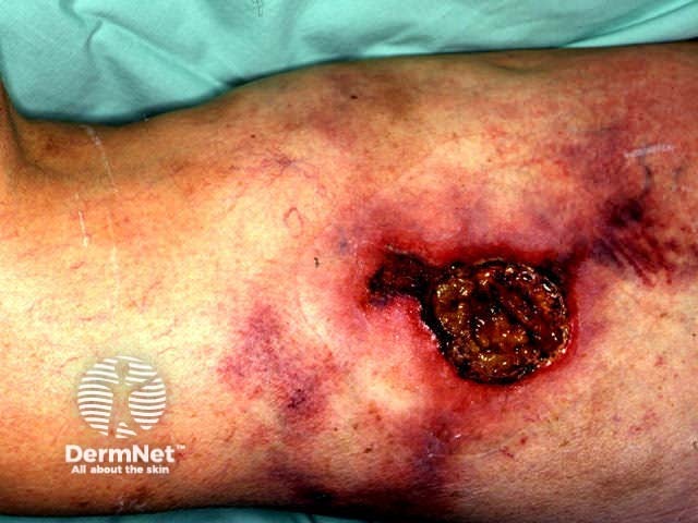 Calciphylaxis