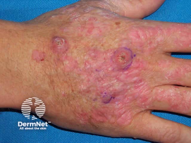 Warts, actinic keratoses and squamous cell carcinomas