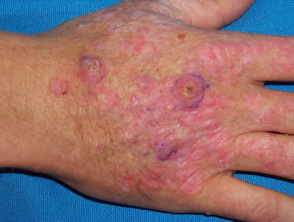 Warts, actinic keratoses and squamous cell carcinomas in renal transplant patient