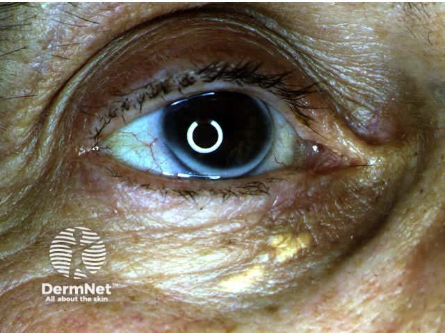 Xanthelasma