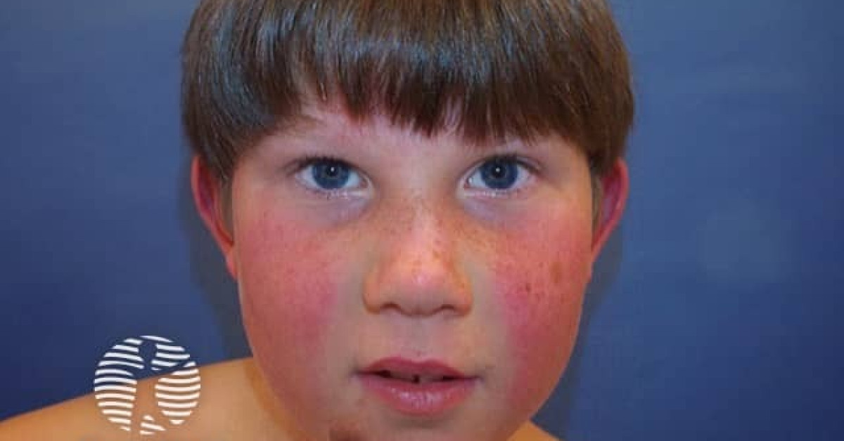 Fifth disease image