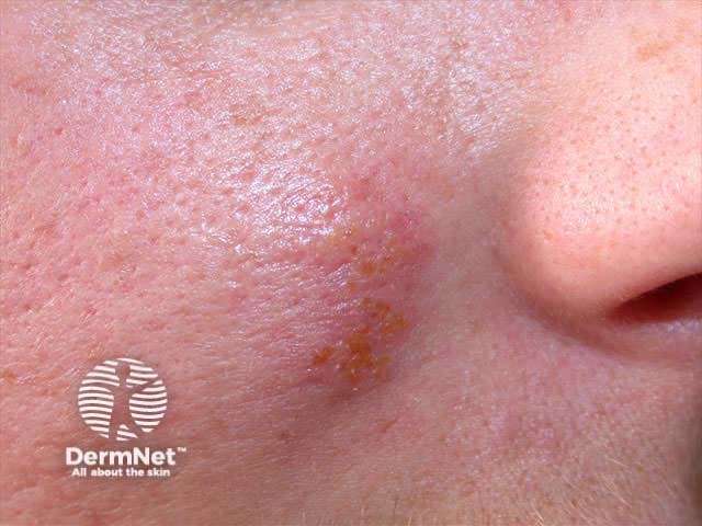 Recurrent facial herpes