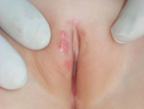 Primary herpes simplex