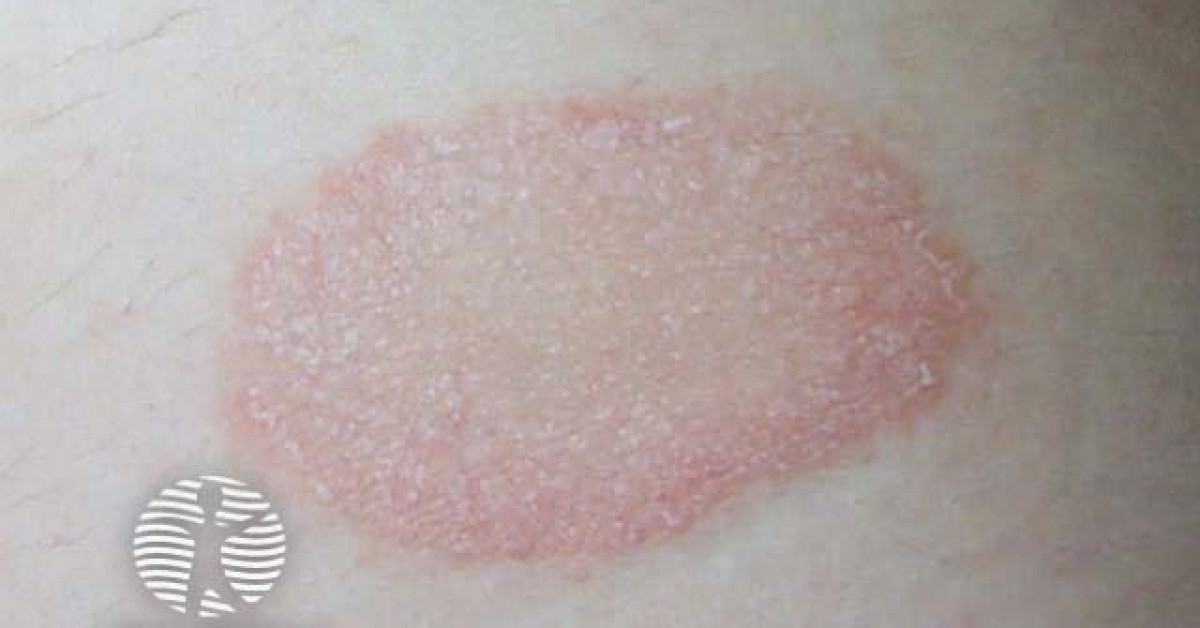 Herald patch: pityriasis rosea image