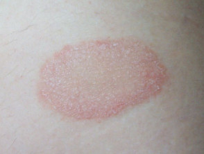 Herald patch: pityriasis rosea
