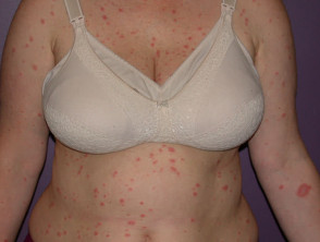Herald patch: pityriasis rosea