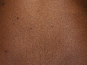Varicella scars