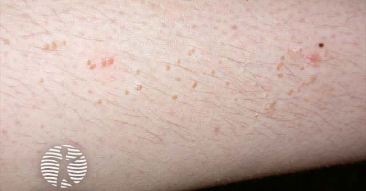 plane-flat-warts-image
