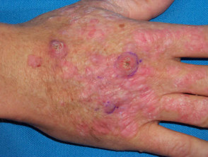 Warts, actinic keratoses and squamous cell carcinomas in a transplant patient