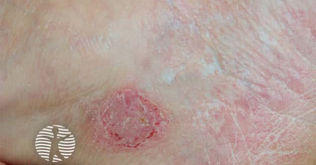 Irritant dermatitis from adhesive plaster image