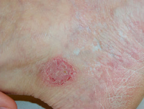 Irritant dermatitis from adhesive plaster