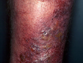 Leg Ulcers Dermnet Nz
