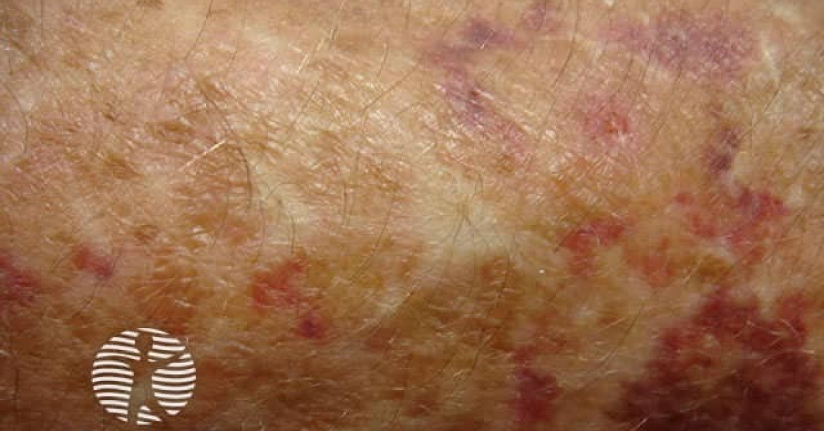 EhlersDanlos syndrome image