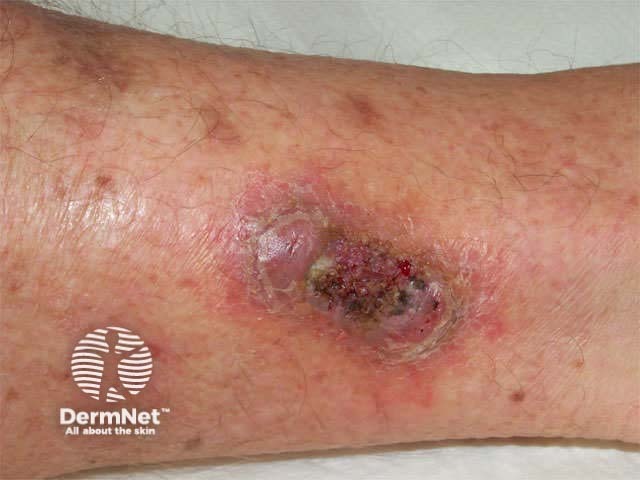Ulceration in patient with haematological malignancy