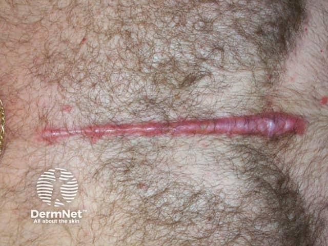 Hypertrophic scar caused by sternotomy