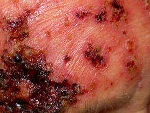 Wound infection after imiquimod to skin cancer