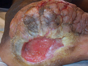 Neuropathic ulceration due to paraplegia 