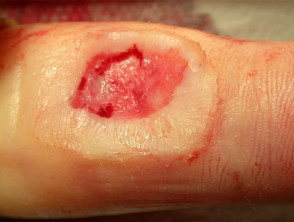 Acute surgical wound