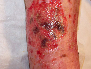 Ulcer due to skin infection