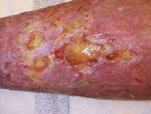 Typical venous ulceration
