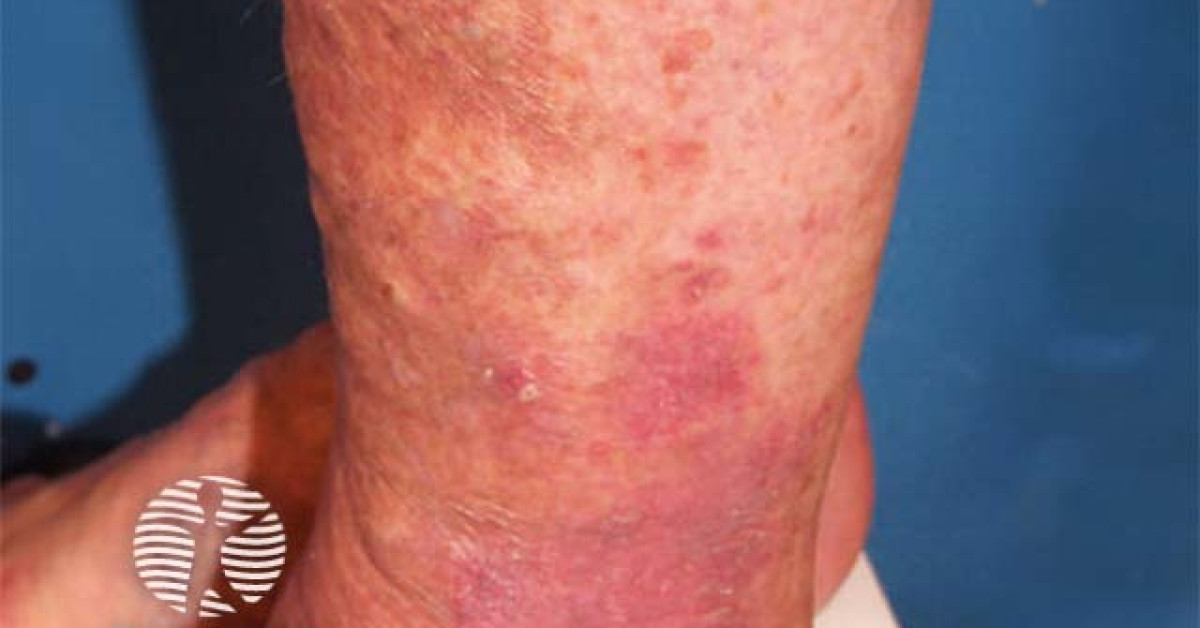 Typical stasis dermatitis image