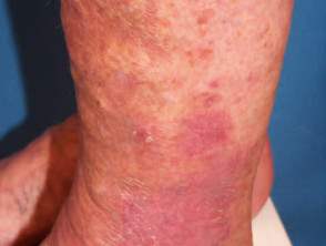 Typical stasis dermatitis