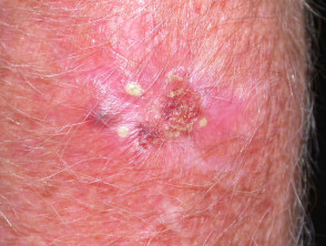 Wound infection after photodynamic therapy