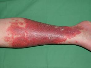 Dermatitis due to zinc bandage 