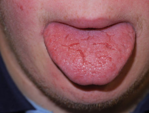 Fissured tongue n Down syndrome
