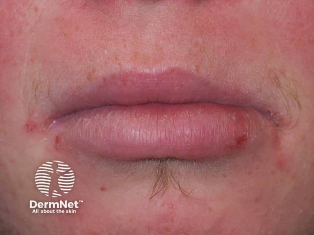 Angular cheilitis in Down syndrome