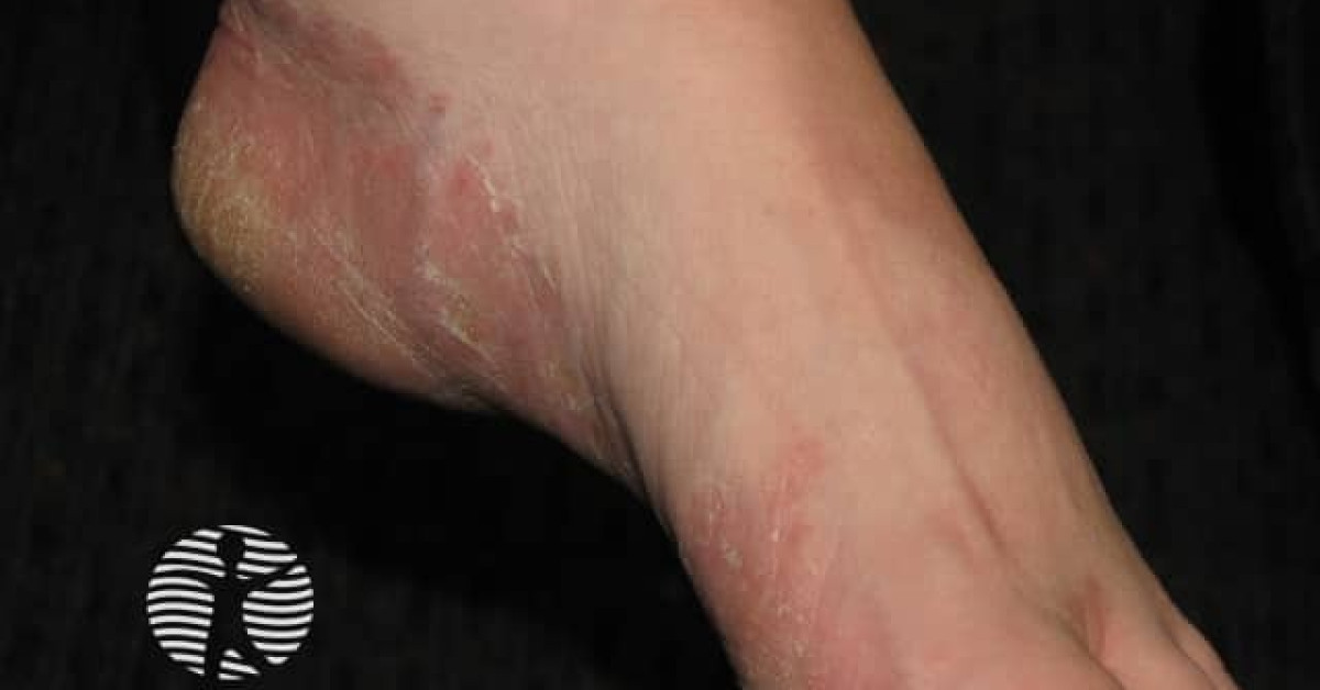 Tinea pedis in Down syndrome image