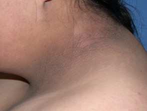  Acanthosis nigricans in Down syndrome