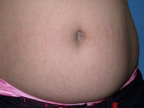 Striae atrophicae associated with obesity and Down syndrome