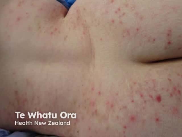 Folliculitis in Down syndrome