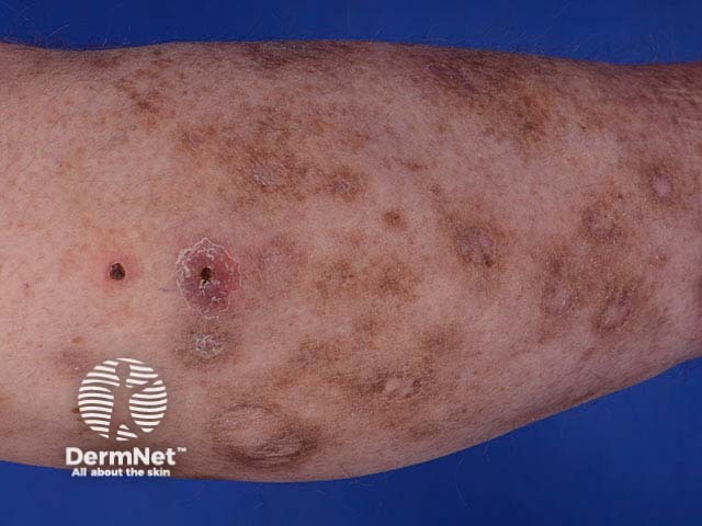 Hyperpigmentation and scarring due to skin infection
