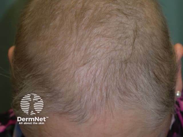Drug-induced diffuse alopecia