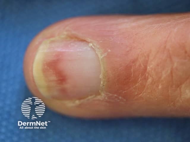 Nail dystrophy induced by hydroxyurea