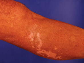 Drug induced vitiligo